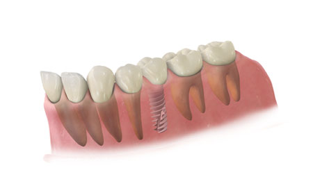 Implant zęba, protezy, korony zębów, odbudowa zęba - Częstochowa, Kłobuck | Protetyka
