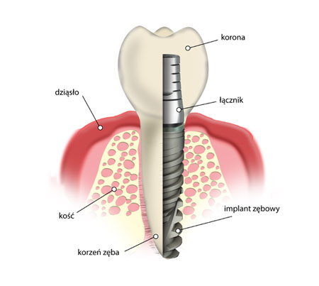 Implanty - Częstochowa, Kłobuck, Radomsko, Lubliniec | Implant zęba